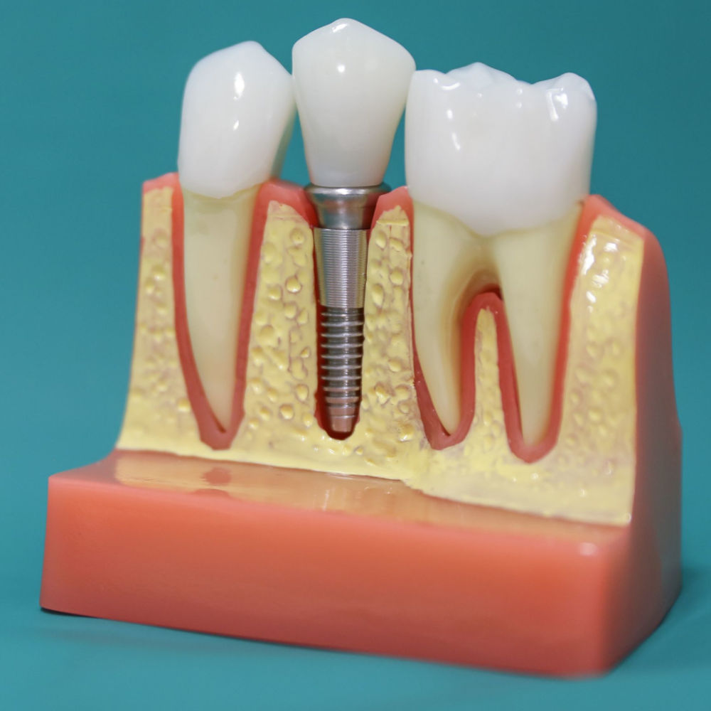 Couronne sur implant