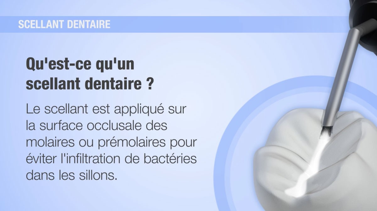 Scellant dentaire